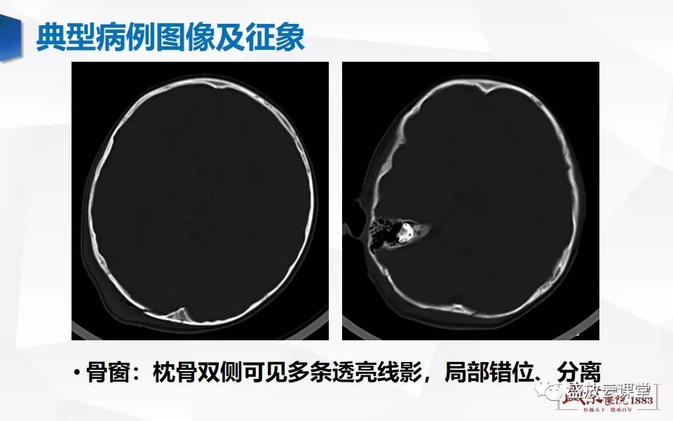 影像PPT - 【PPT】颅脑外伤（颅骨骨折）-5