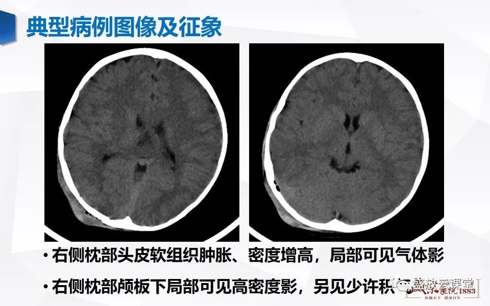 影像PPT - 【PPT】颅脑外伤（颅骨骨折）-4