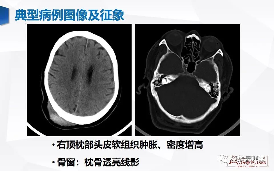 影像PPT - 【PPT】颅脑外伤（颅骨骨折）-10