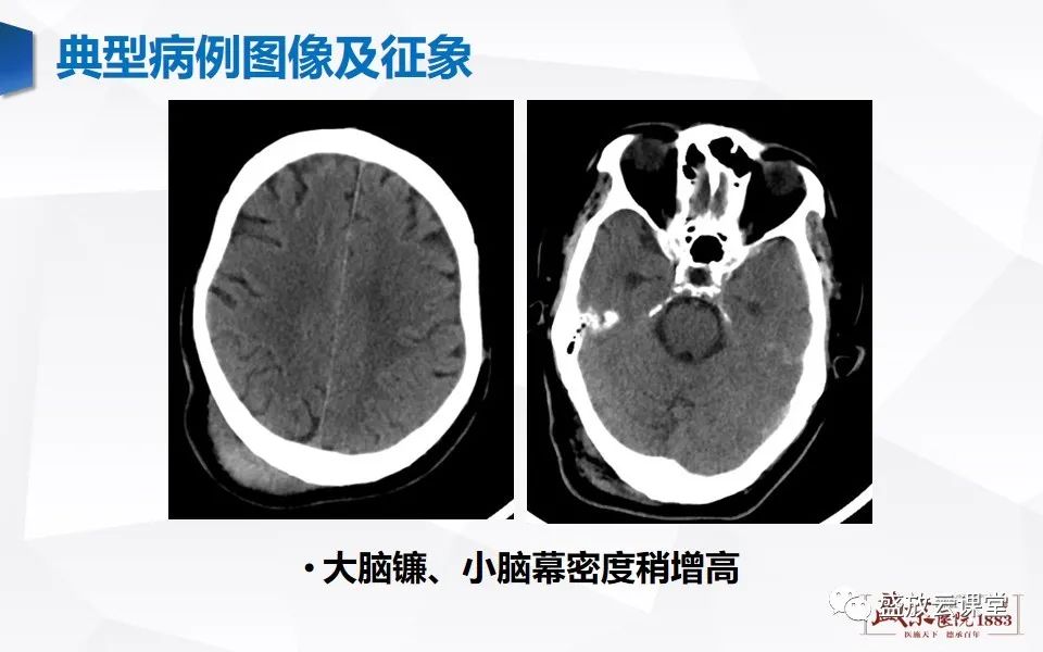 影像PPT - 【PPT】颅脑外伤（颅骨骨折）-12