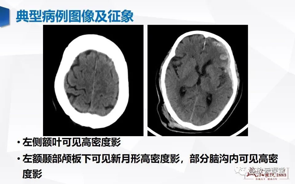 影像PPT - 【PPT】颅脑外伤（颅骨骨折）-11