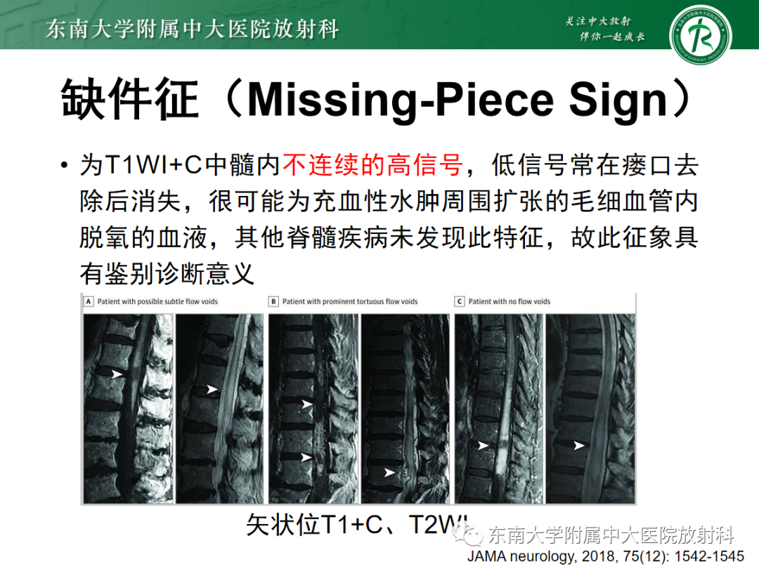影像PPT - 【PPT】硬脊膜动静脉瘘-16