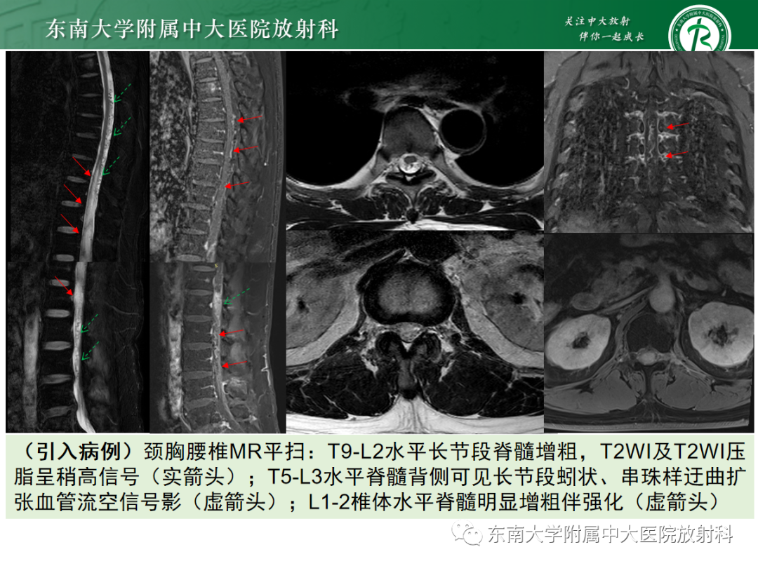 影像PPT - 【PPT】硬脊膜动静脉瘘-19
