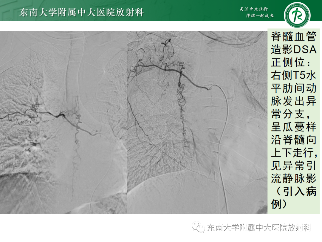 影像PPT - 【PPT】硬脊膜动静脉瘘-20