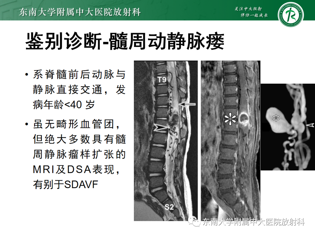 影像PPT - 【PPT】硬脊膜动静脉瘘-22