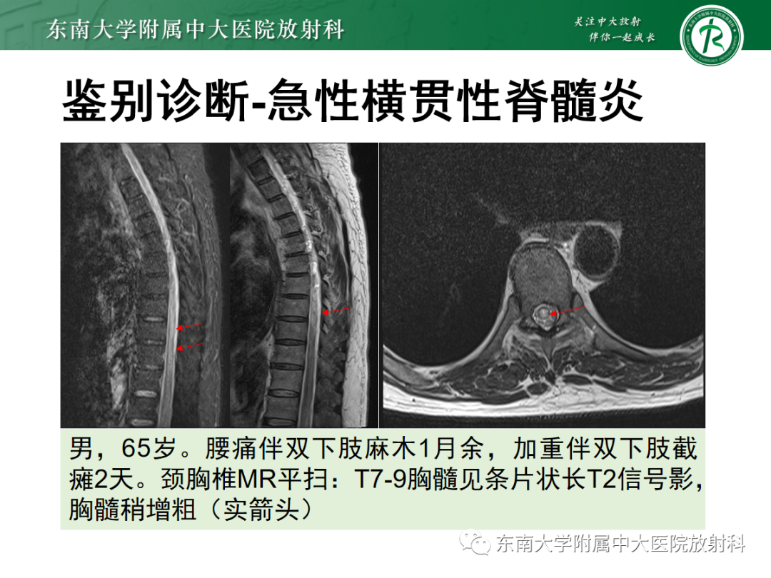 影像PPT - 【PPT】硬脊膜动静脉瘘-26