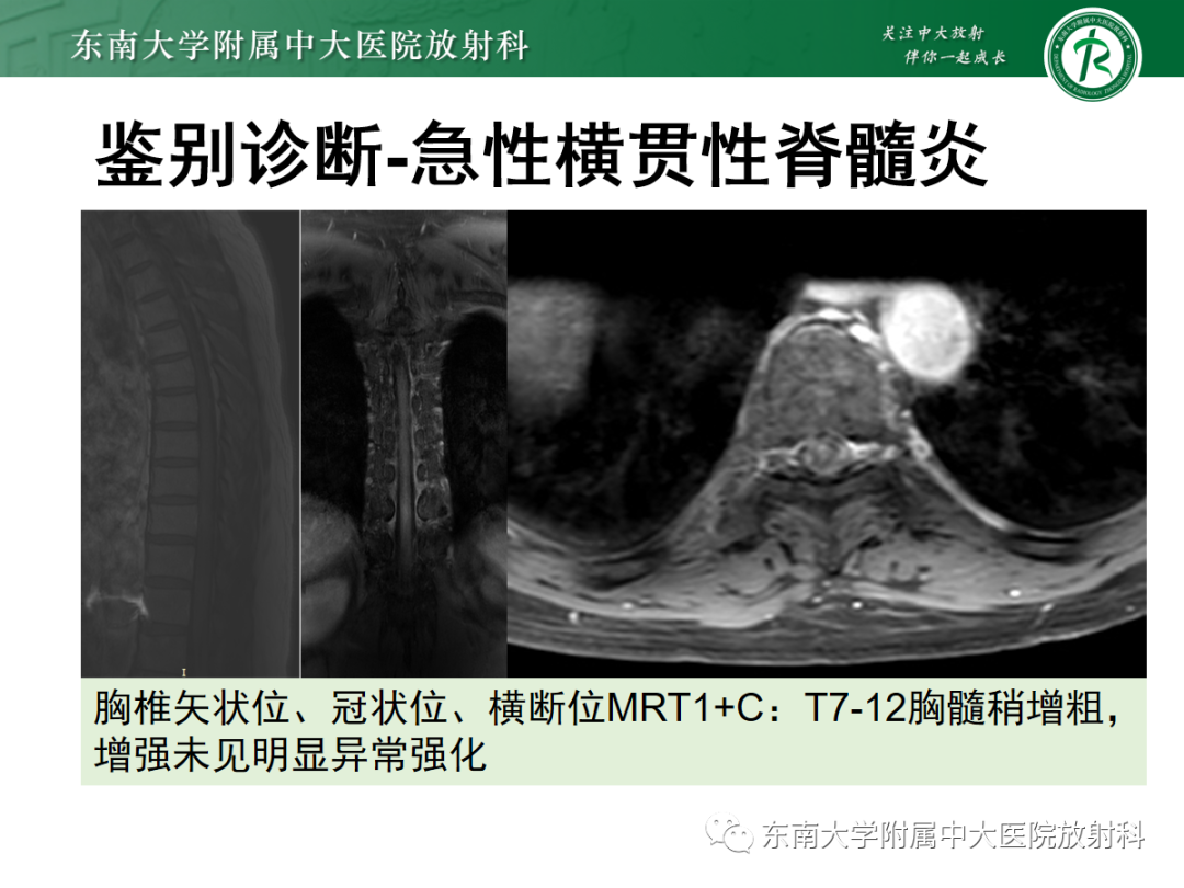 影像PPT - 【PPT】硬脊膜动静脉瘘-27