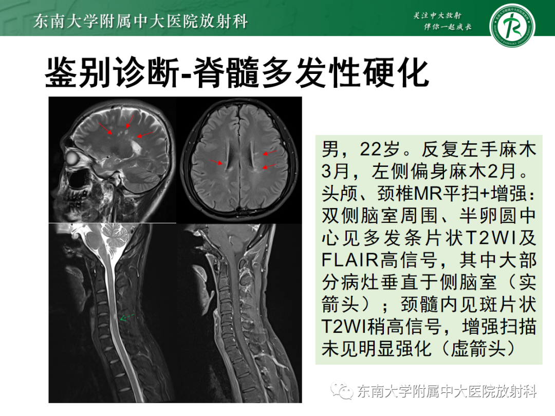 影像PPT - 【PPT】硬脊膜动静脉瘘-30