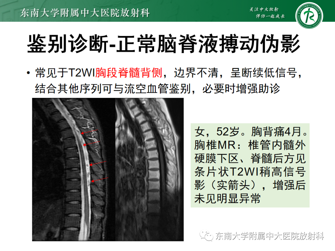 影像PPT - 【PPT】硬脊膜动静脉瘘-33