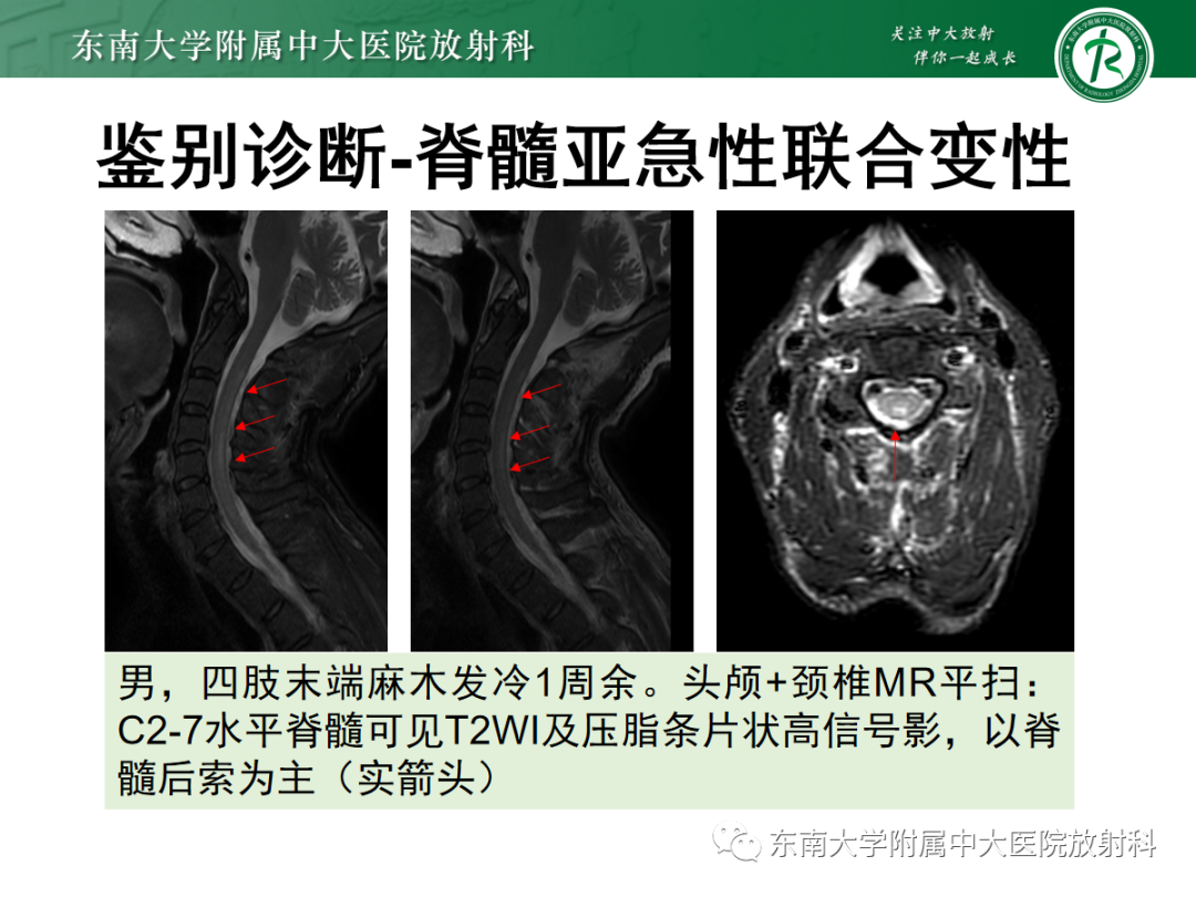 影像PPT - 【PPT】硬脊膜动静脉瘘-32