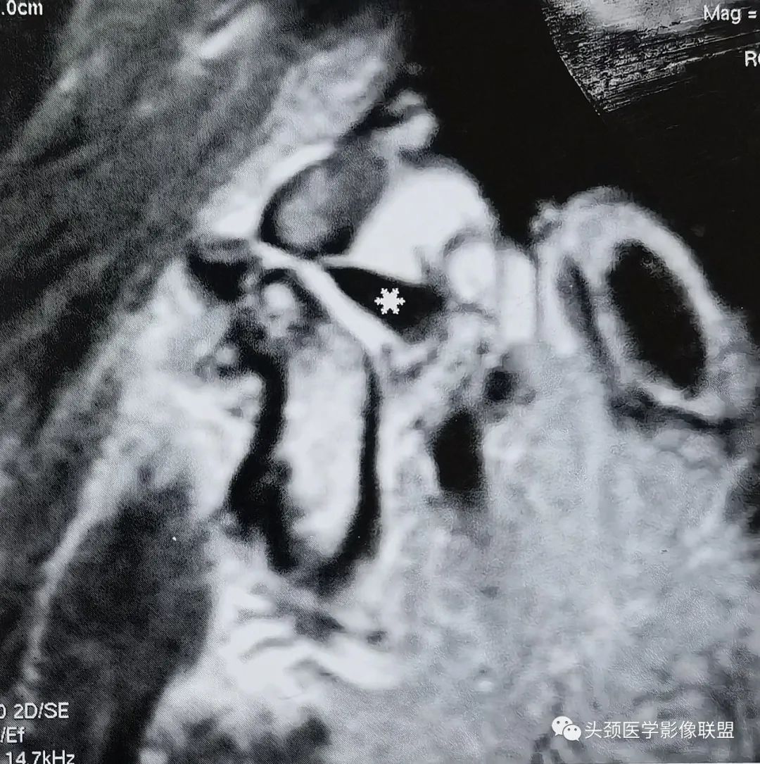 影像PPT - 颞下颌关节盘粘连和穿孔-2 影像PPT - 颞下颌关节盘粘连和穿孔-2