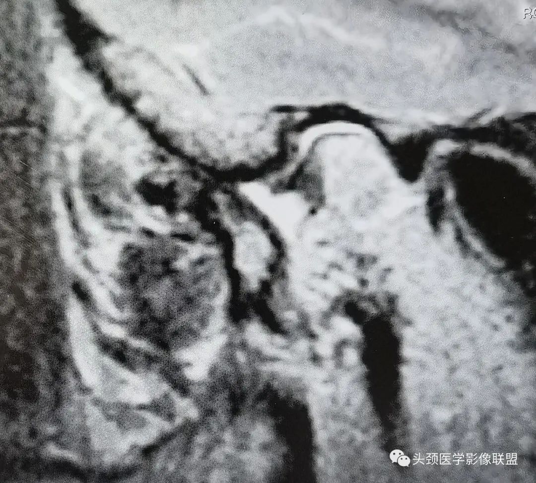 影像PPT - 颞下颌关节盘粘连和穿孔-3 影像PPT - 颞下颌关节盘粘连和穿孔-3