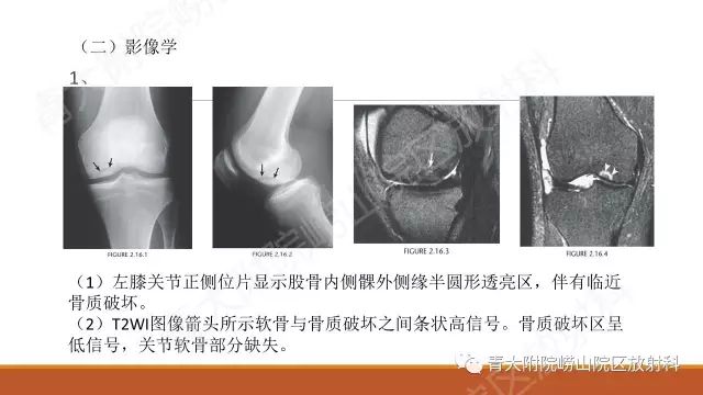 影像PPT - 【PPT】剥脱性骨软骨炎-8