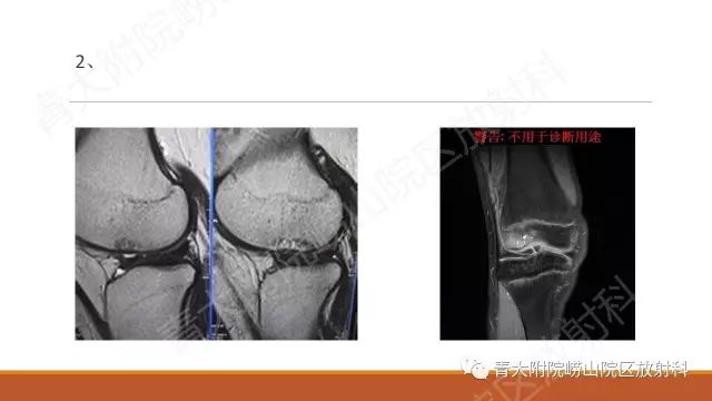 影像PPT - 【PPT】剥脱性骨软骨炎-9
