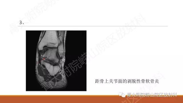 影像PPT - 【PPT】剥脱性骨软骨炎-10