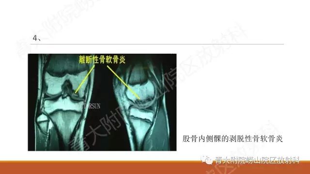 影像PPT - 【PPT】剥脱性骨软骨炎-11