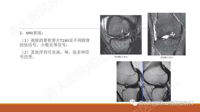 影像PPT - 【PPT】剥脱性骨软骨炎-13