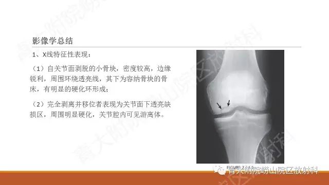 影像PPT - 【PPT】剥脱性骨软骨炎-12