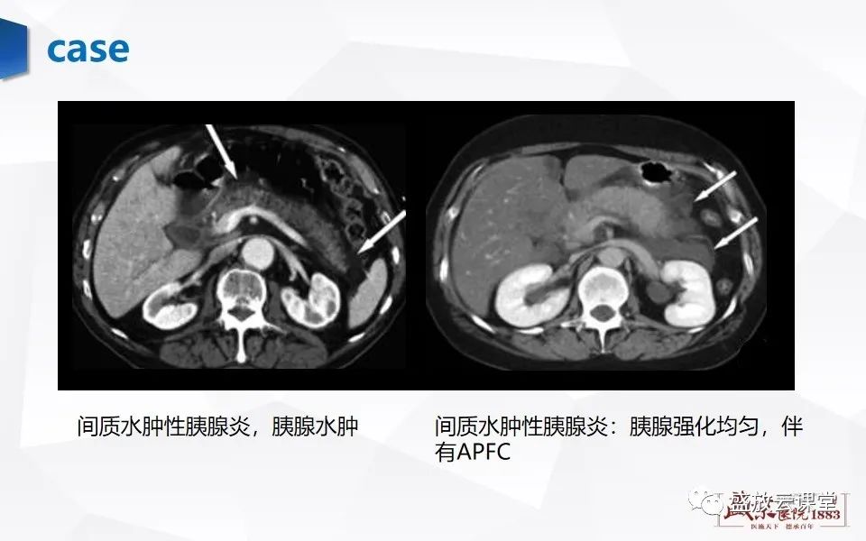 影像PPT - 【PPT】胰腺炎影像表现-12