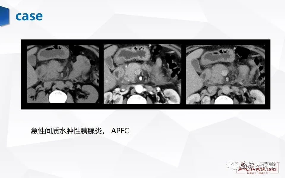 影像PPT - 【PPT】胰腺炎影像表现-13