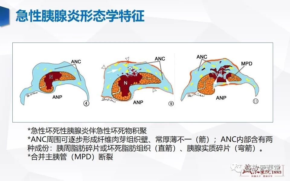 影像PPT - 【PPT】胰腺炎影像表现-17