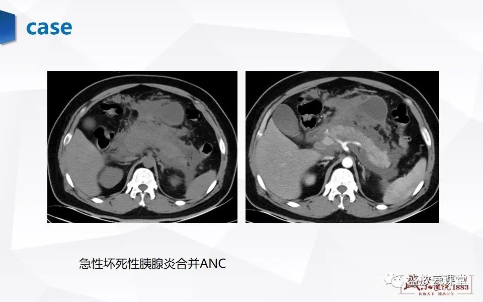影像PPT - 【PPT】胰腺炎影像表现-18
