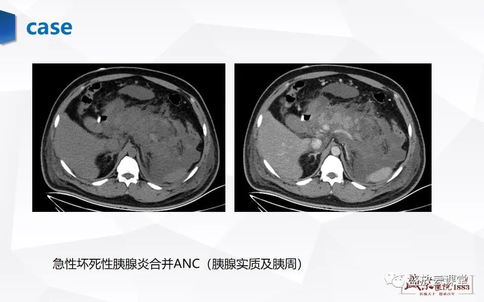 影像PPT - 【PPT】胰腺炎影像表现-19