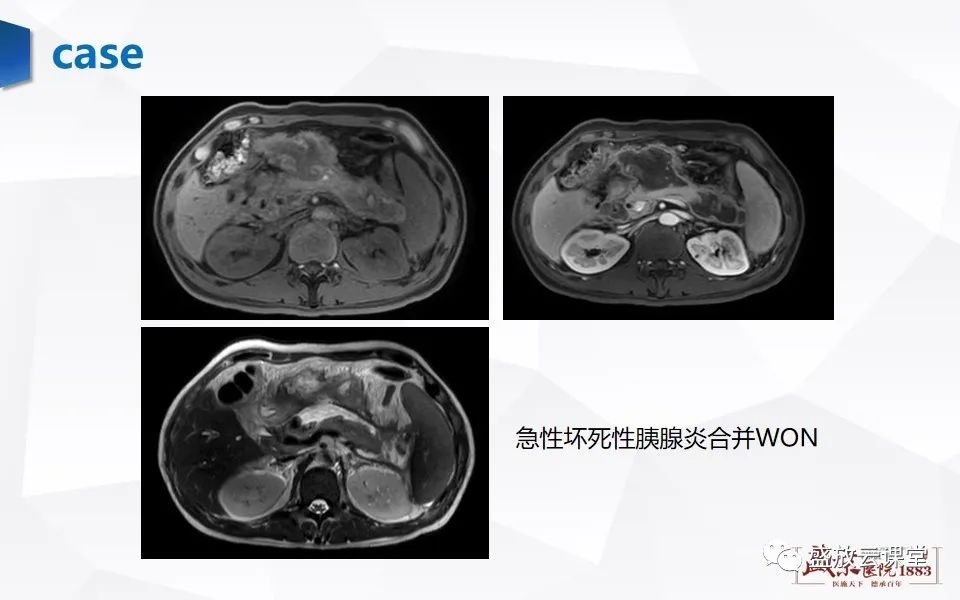 影像PPT - 【PPT】胰腺炎影像表现-23