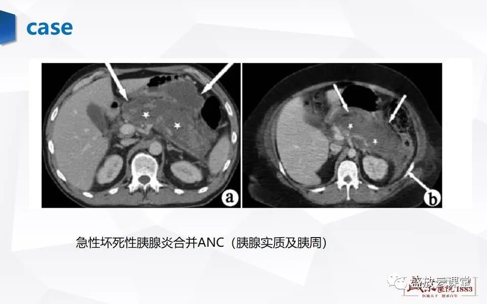 影像PPT - 【PPT】胰腺炎影像表现-20