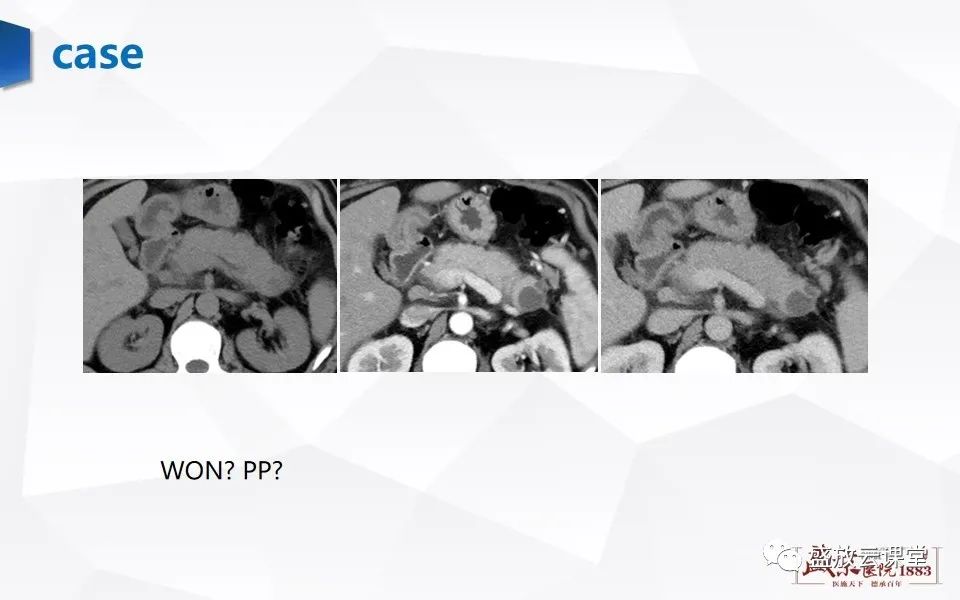 影像PPT - 【PPT】胰腺炎影像表现-27