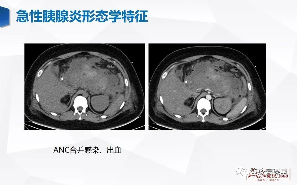 影像PPT - 【PPT】胰腺炎影像表现-30