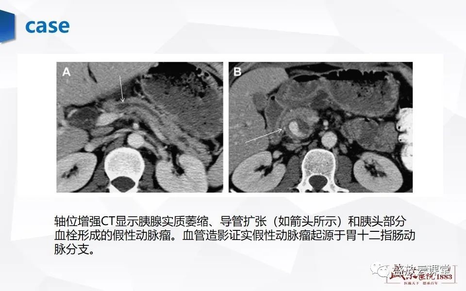 影像PPT - 【PPT】胰腺炎影像表现-46