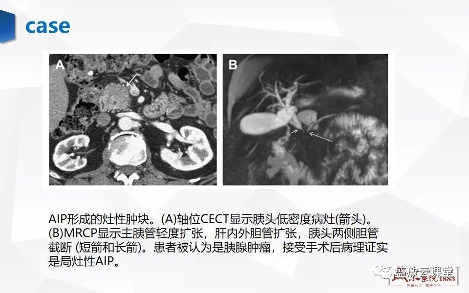 影像PPT - 【PPT】胰腺炎影像表现-58