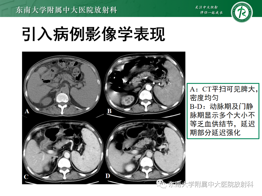 影像PPT - 【PPT】脾脏窦岸细胞血管瘤-3