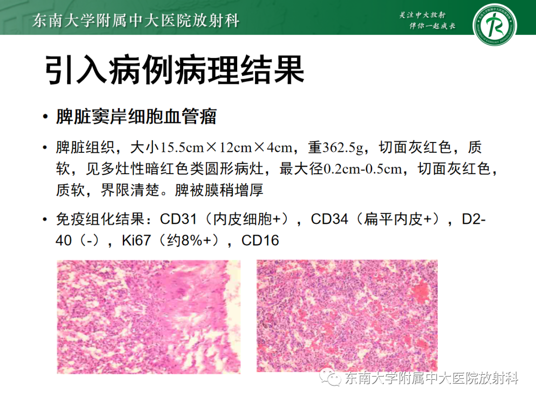 影像PPT - 【PPT】脾脏窦岸细胞血管瘤-4
