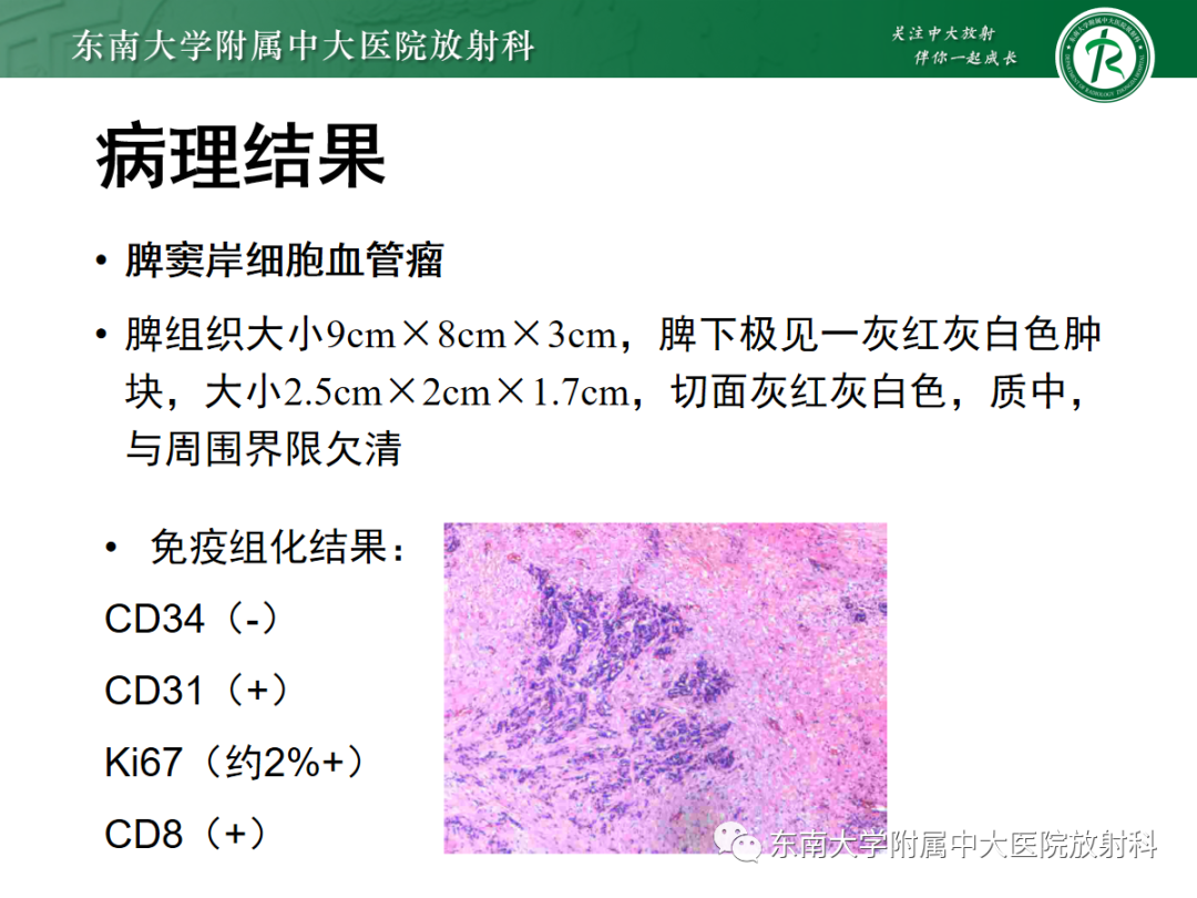影像PPT - 【PPT】脾脏窦岸细胞血管瘤-10