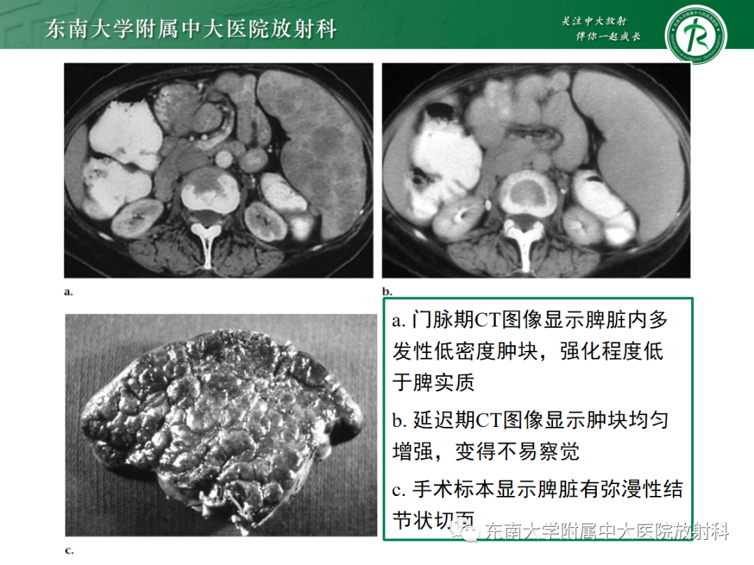 影像PPT - 【PPT】脾脏窦岸细胞血管瘤-11