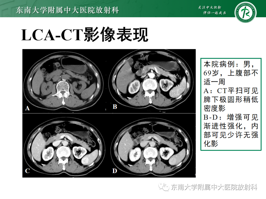 影像PPT - 【PPT】脾脏窦岸细胞血管瘤-9