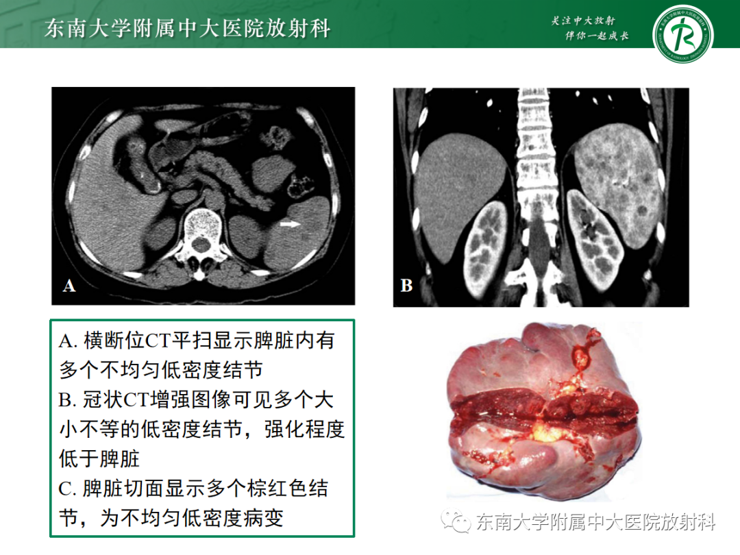 影像PPT - 【PPT】脾脏窦岸细胞血管瘤-12