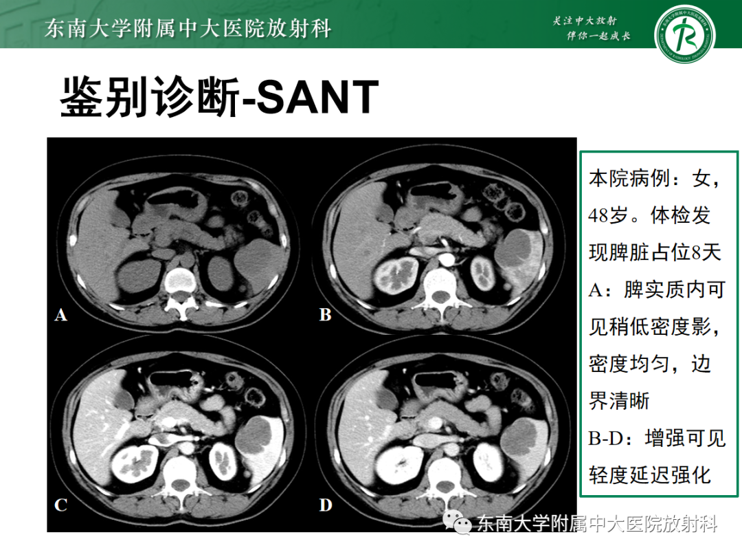 影像PPT - 【PPT】脾脏窦岸细胞血管瘤-16