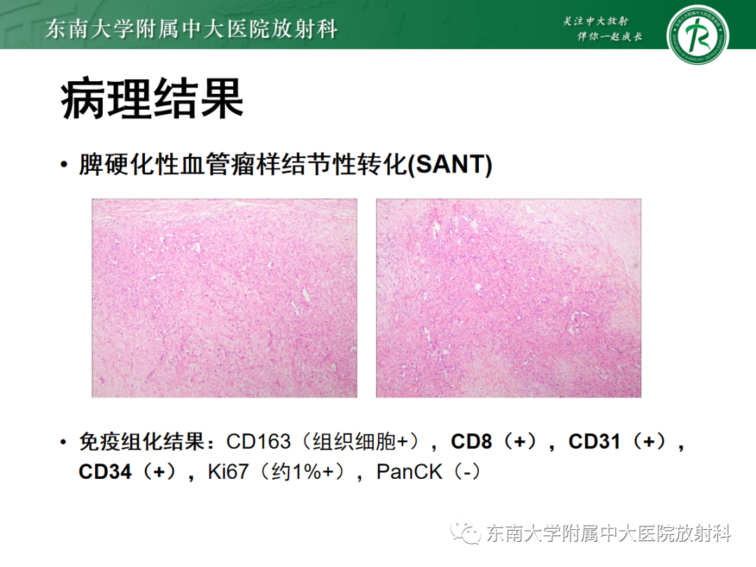 影像PPT - 【PPT】脾脏窦岸细胞血管瘤-17