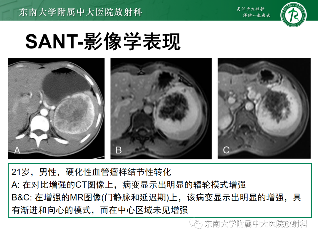影像PPT - 【PPT】脾脏窦岸细胞血管瘤-20