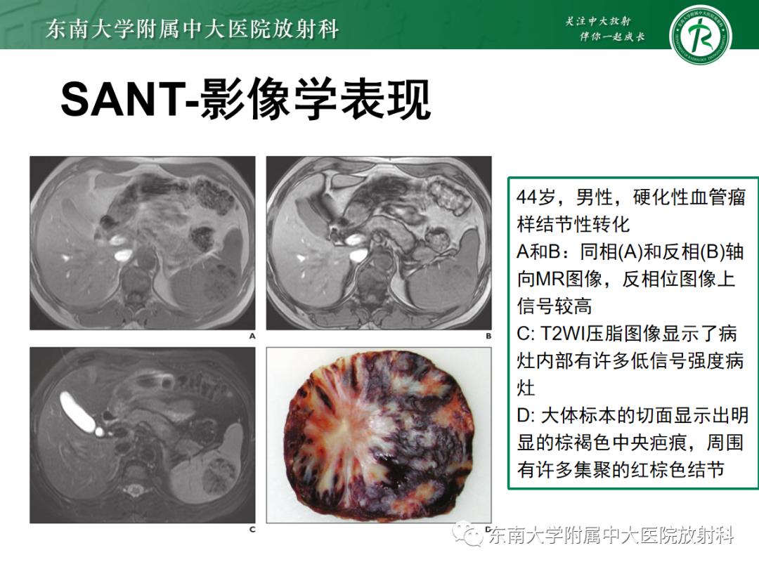 影像PPT - 【PPT】脾脏窦岸细胞血管瘤-22