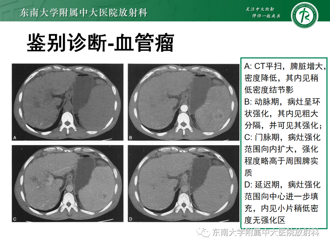 影像PPT - 【PPT】脾脏窦岸细胞血管瘤-25