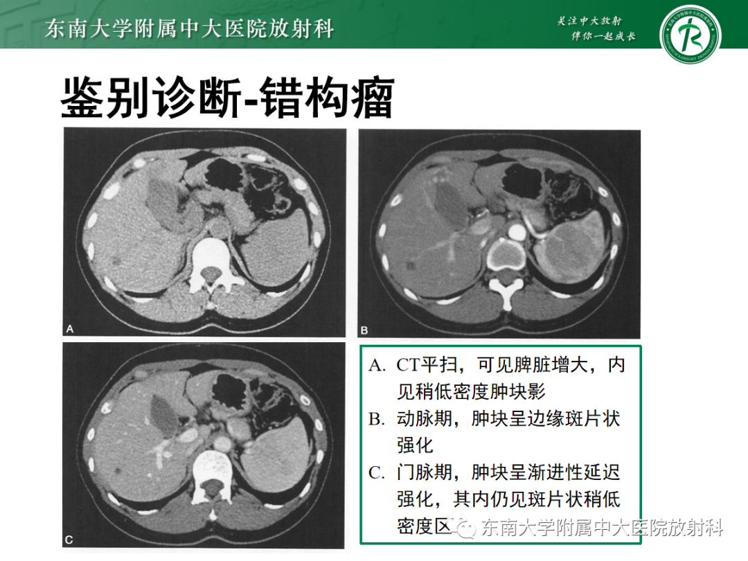 影像PPT - 【PPT】脾脏窦岸细胞血管瘤-27
