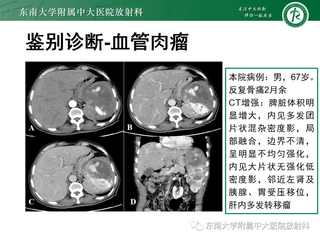 影像PPT - 【PPT】脾脏窦岸细胞血管瘤-30
