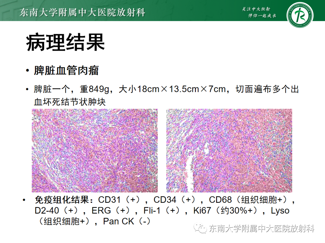 影像PPT - 【PPT】脾脏窦岸细胞血管瘤-31