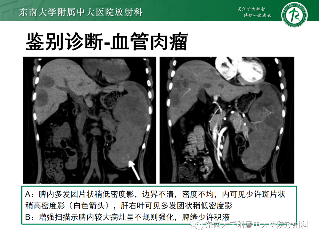 影像PPT - 【PPT】脾脏窦岸细胞血管瘤-32