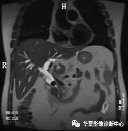 影像PPT - Mirizzi综合征的影像表现及诊断-3