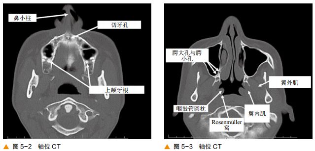 影像PPT - 颅底及鼻窦CT轴冠矢解剖-3
